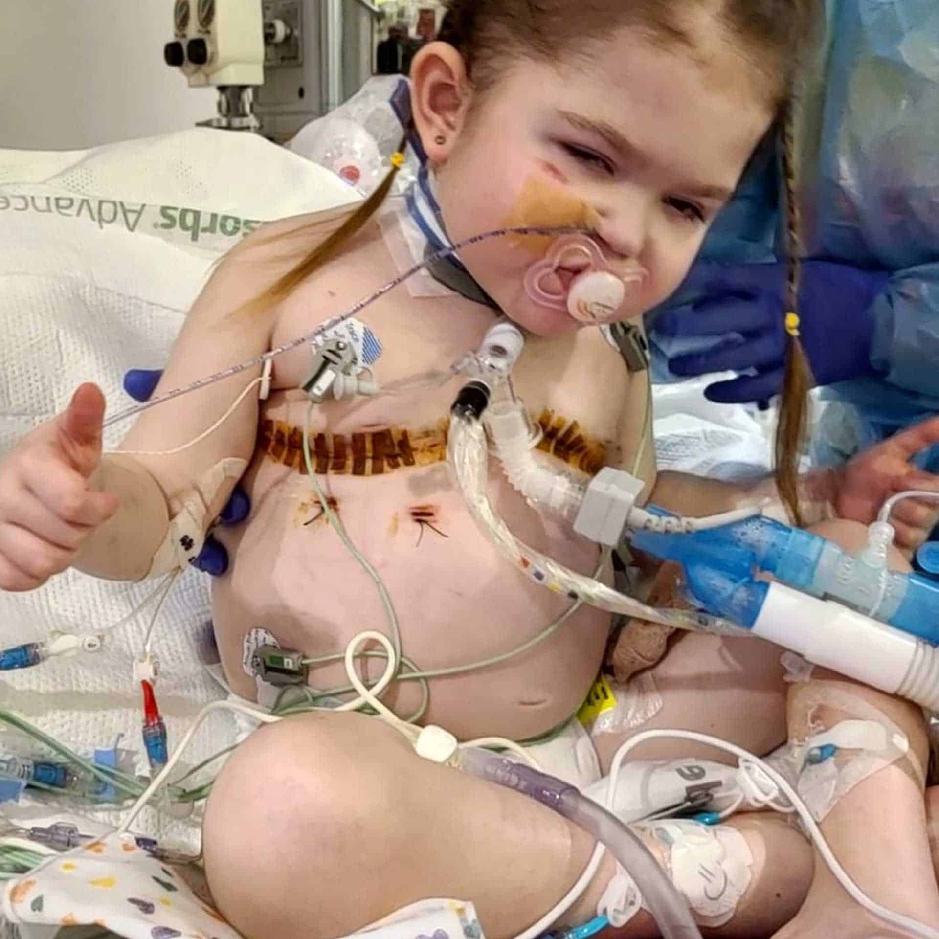 A child in a hospital bed with medical devices attached, including a breathing tube and various monitors. The child appears lively and is giving a thumbs-up gesture with one hand.